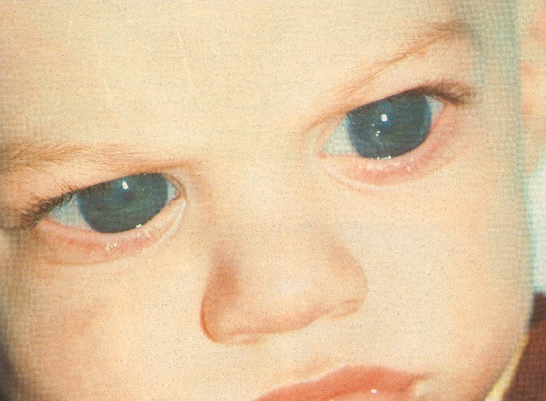 Glaucoma infantile