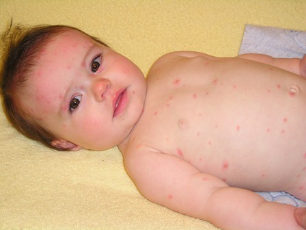 bambina con la varicella