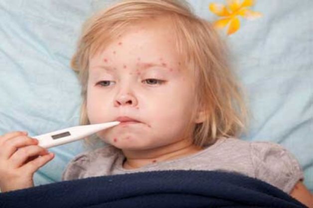 Vaccino antivaricella morbillo e rosolia nei bambini
