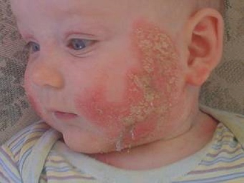come si manifestano le allergie sulla pelle dei bambini