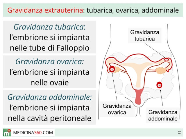 gravidanza extrauterina cosa fare