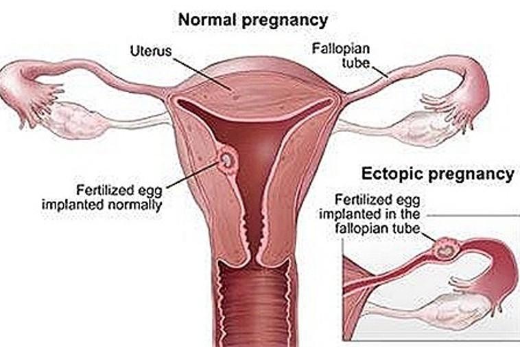 gravidanza extrauterina esami di prevenzione 5e53e08009a8020ca99ce81c8b645377