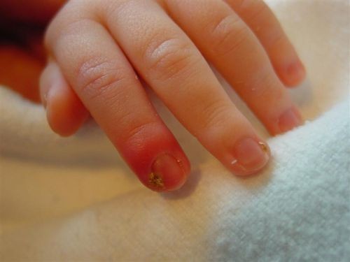 Come curare funghi unghie bambini