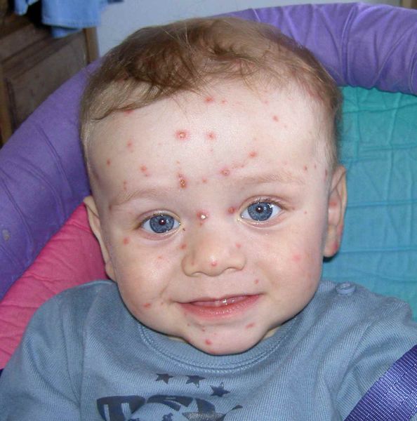 Durata febbre bambini dopo vaccino varicella