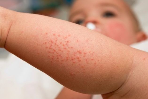 Come prevenire dermatite da contatto bambini