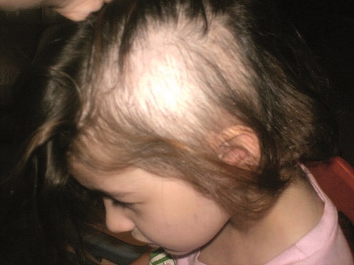 come curare l'alopecia da stress nei piccoli