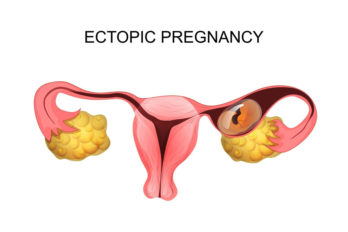 Gravidanza extrauterina