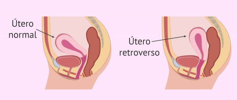 Utero retroverso in gravidanza