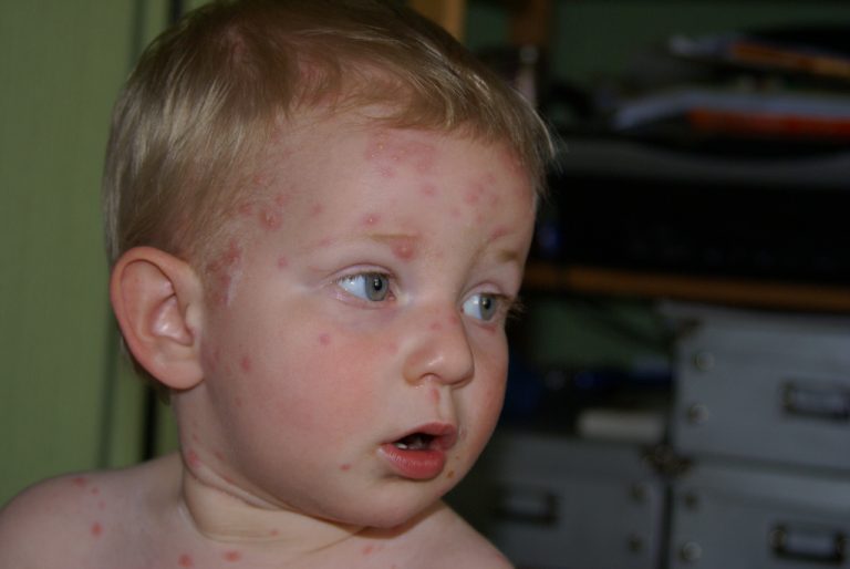 Come riconoscere la varicella nei bambini