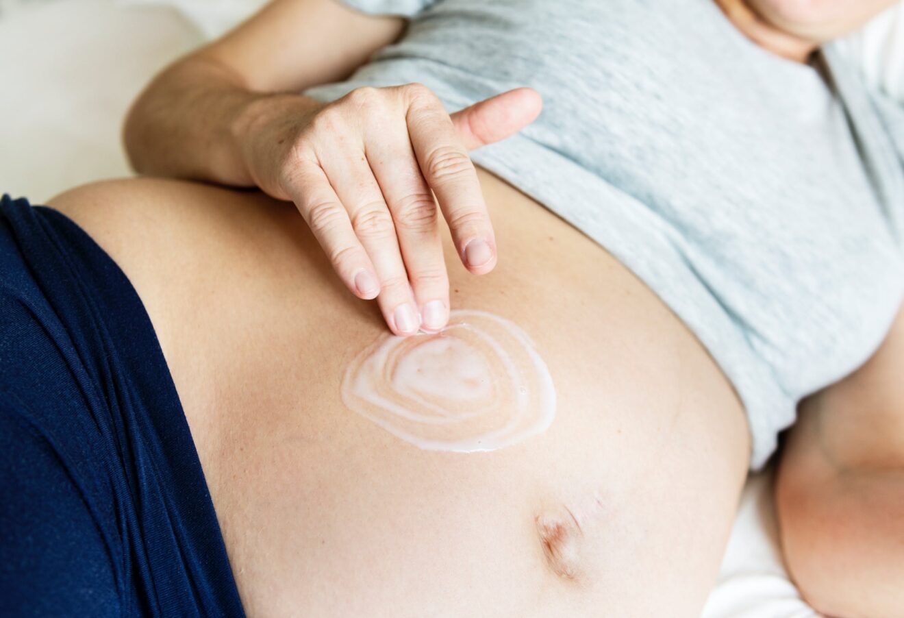 Smagliature in gravidanza: come combatterla