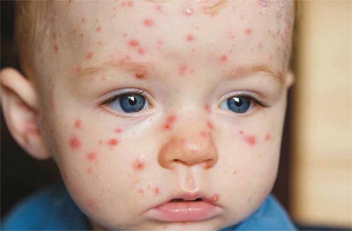 Come evitare le macchie da varicella