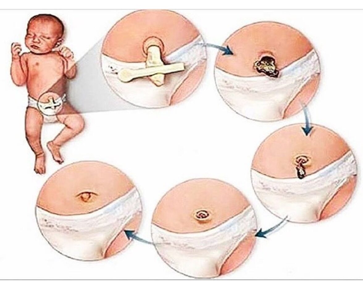 Come curare ombelico neonato