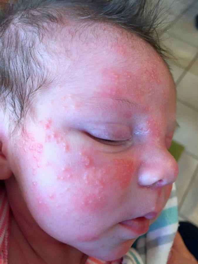 Eruzioni cutanee nel bambino acne