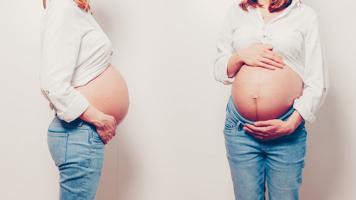 come limitare la diastasi in gravidanza