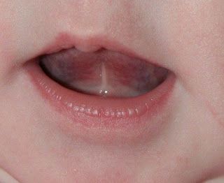 Legatura della lingua bambino sintomi