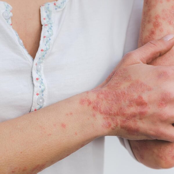Psoriasi, i suggerimenti per la donna in età fertile e in gravidanza