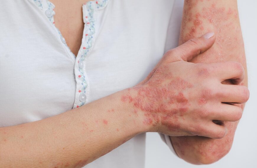 Psoriasi, i suggerimenti per la donna in età fertile e in gravidanza