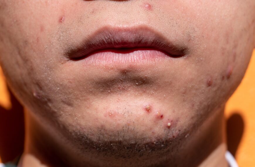 Adolescenti e acne: quale percorso da seguire? Una guida per i genitori