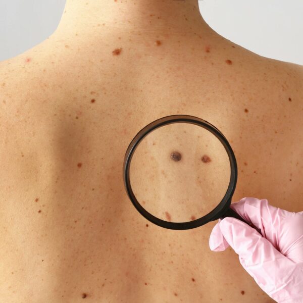 Sole e melanoma, la SIDeMaST contro le fake news