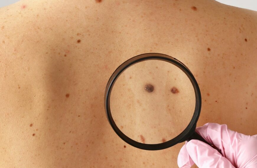 Sole e melanoma, la SIDeMaST contro le fake news