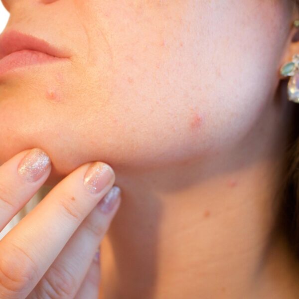 Acne, in aumento i casi tra le donne adulte