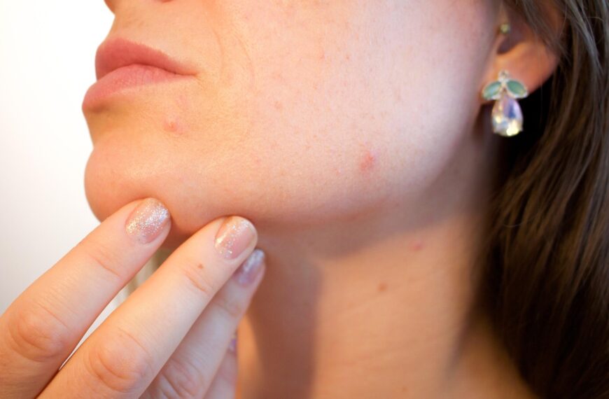 Acne, in aumento i casi tra le donne adulte