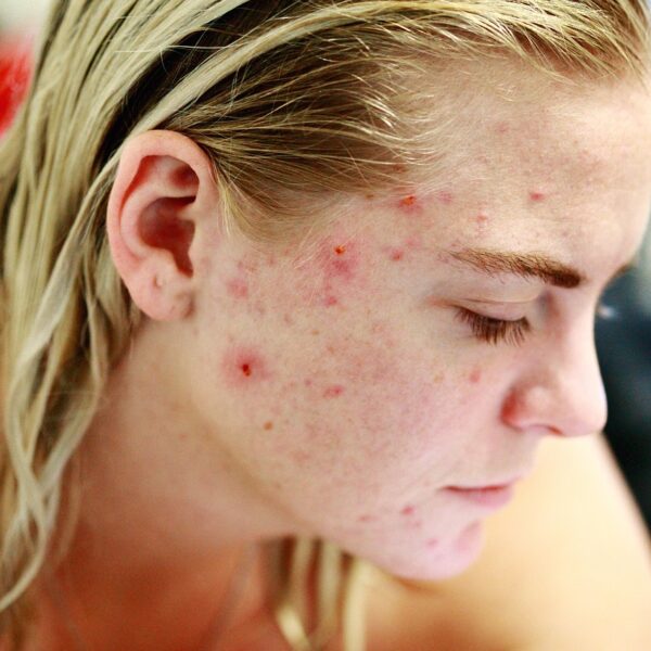 «Non è solo qualche brufolo», ecco quando è il momento di rivolgersi al dermatologo
