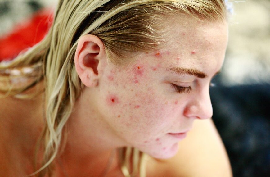 «Non è solo qualche brufolo», ecco quando è il momento di rivolgersi al dermatologo